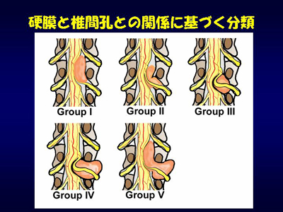 neurinomaclassification.jpg